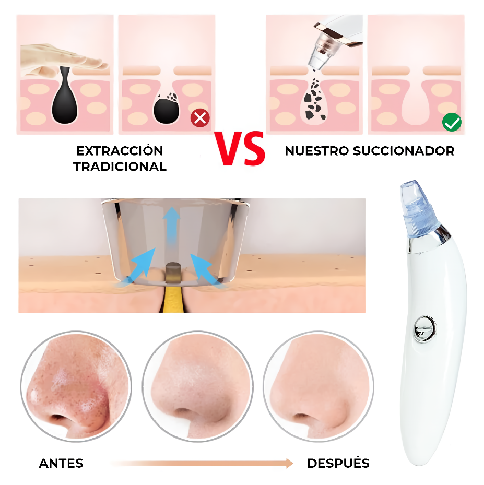 DermaSuction - Puntos Negros y Espinillas